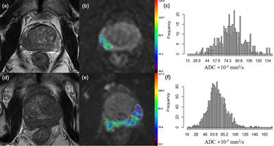 Incremental prognostic value of ADC histogram analysis in patients with high-risk prostate cancer receiving adjuvant hormonal therapy after radical prostatectomy